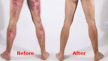 psoriasis free for life ingredients