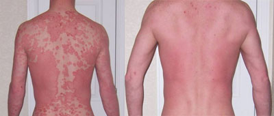 Psoriasis Free For Life